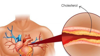 Kolesterol Tinggi Picu Serangan Jantung, Kok Bisa? Ini Penjelasannya