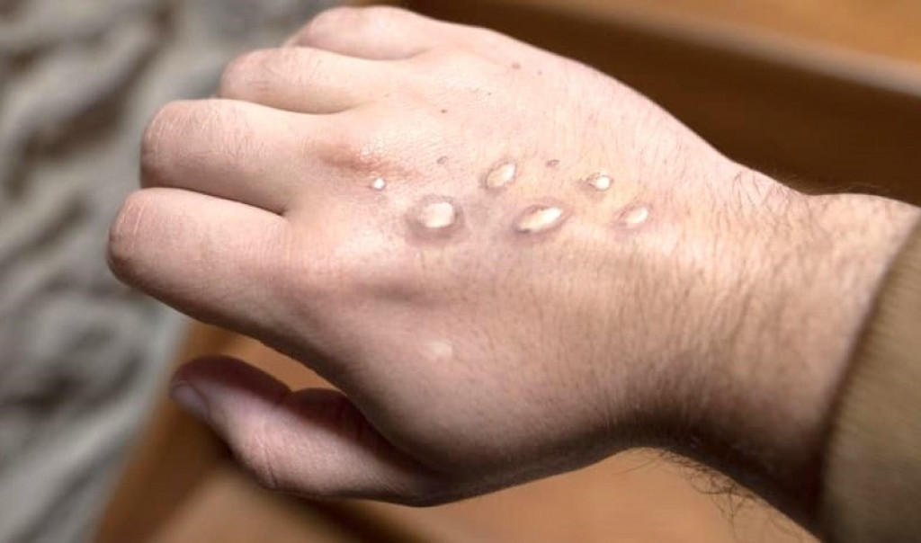 WHO Resmi Cabut Status Darurat Cacar Monyet