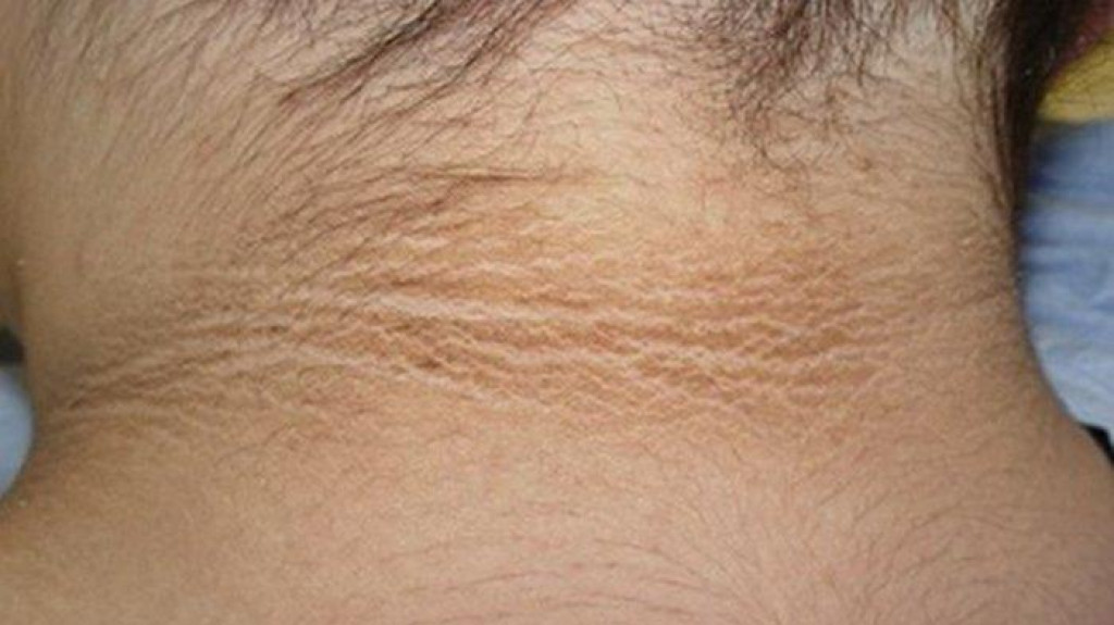 Simak! Ini Penyebab Kenapa Lipatan Leher Menghitam