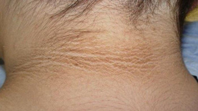 Simak! Ini Penyebab Kenapa Lipatan Leher Menghitam